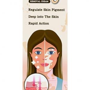 Jouyzan Vitiligo Cream – Natural Treatment to Improve Skin Pigmentation
