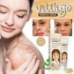 Jouyzan Vitiligo Cream – Natural Treatment to Improve Skin Pigmentation