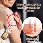 Jouyzan Vitiligo Cream – Natural Treatment to Improve Skin Pigmentation