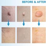2-in-1 Skin Tag Remover Kit – Easy & Safe