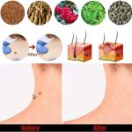 DouBX Hom Wart Remover Freeze Off – Wart Cream for Genital Warts